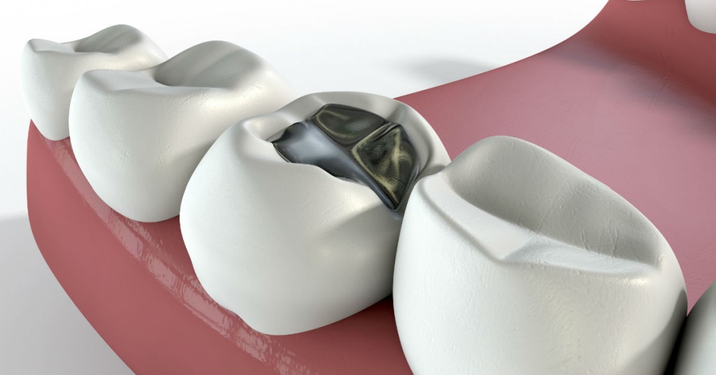Choosing_The_Best_Dental_Fillings_For_Your_Teeth