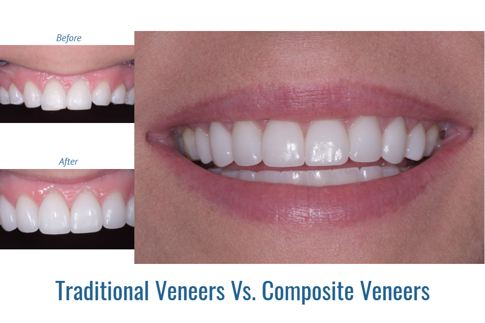 Traditional Veneers Vs Composite Veneers Riverside Dental | Free Nude ...