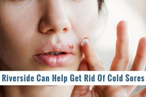 Riverside Can Help Get Rid Of Cold Sores