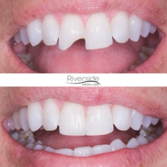 Chipped Tooth Repair  CS Family Dentistry Smile Gallery