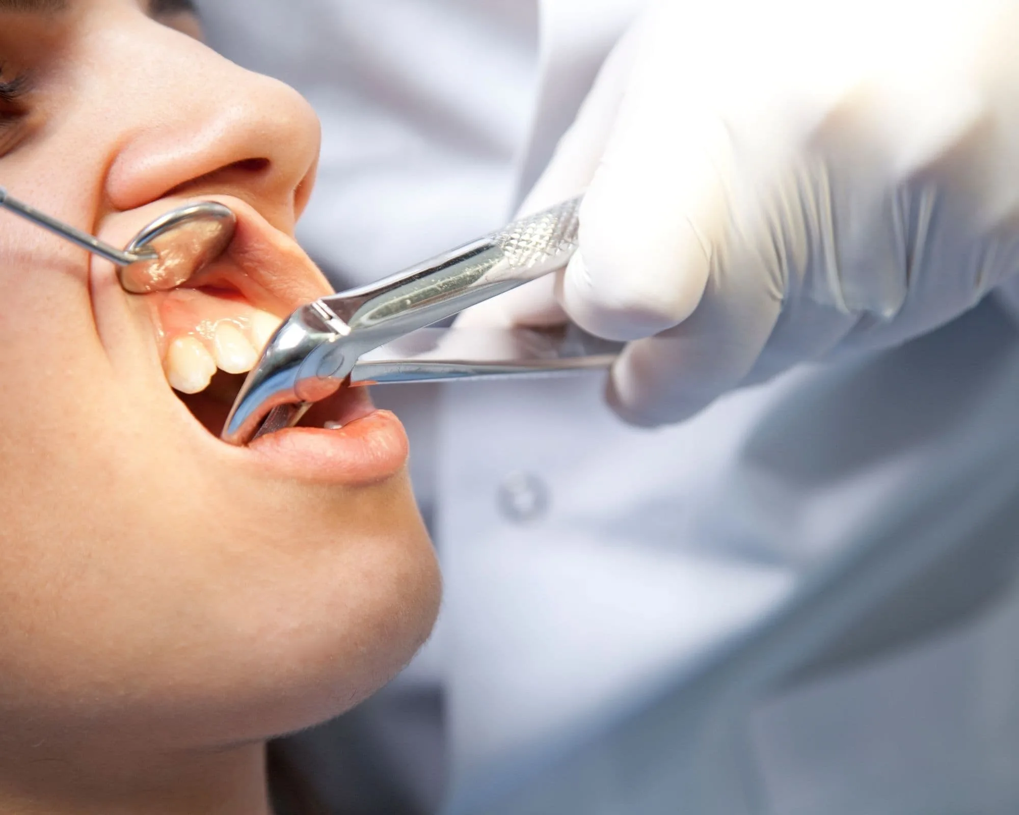 Tooth Extraction