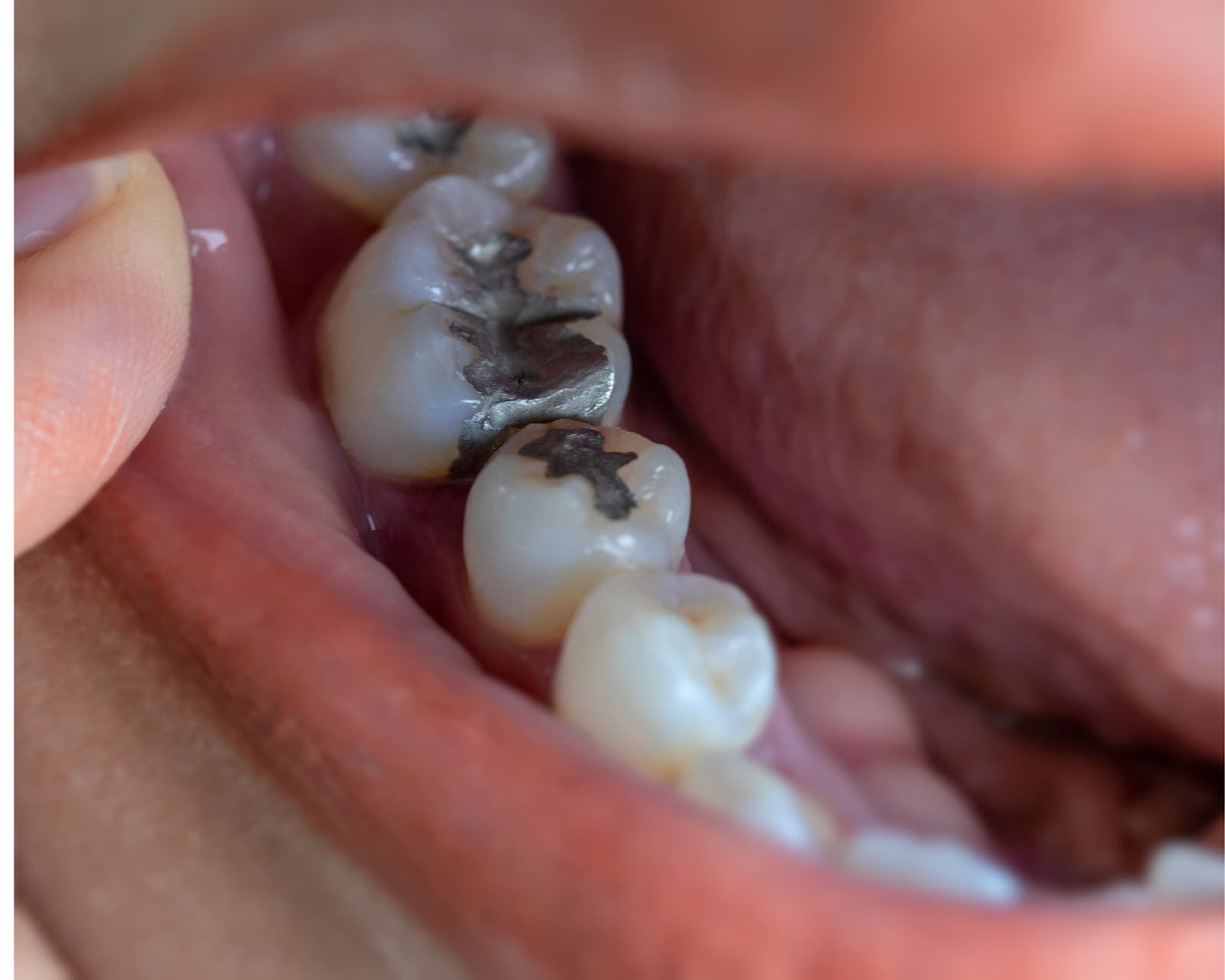 how-often-do-you-need-to-replace-fillings-riverside-dental